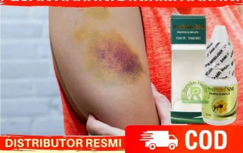 10 Luka Memar dan Bekas Penyiksaan yang Ditemukan di Tubuh Zahra Lantong, Ungkap Keluarga: Kami Lihat Sendiri