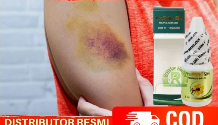 10 Luka Memar dan Bekas Penyiksaan yang Ditemukan di Tubuh Zahra Lantong, Ungkap Keluarga: Kami Lihat Sendiri