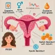 Mengenal Lebih Dalam PMOS: Sindrom Metabolik Ovarium yang Menggantikan PCOS