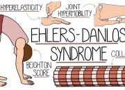 Penderita Hypermobile Ehlers-Danlos Syndrome Berbagi Pengalaman Hidup dengan Kesakitan Kronis