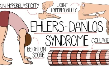 Penderita Hypermobile Ehlers-Danlos Syndrome Berbagi Pengalaman Hidup dengan Kesakitan Kronis