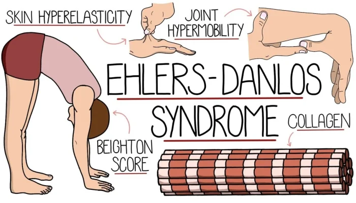 Penderita Hypermobile Ehlers-Danlos Syndrome Berbagi Pengalaman Hidup dengan Kesakitan Kronis