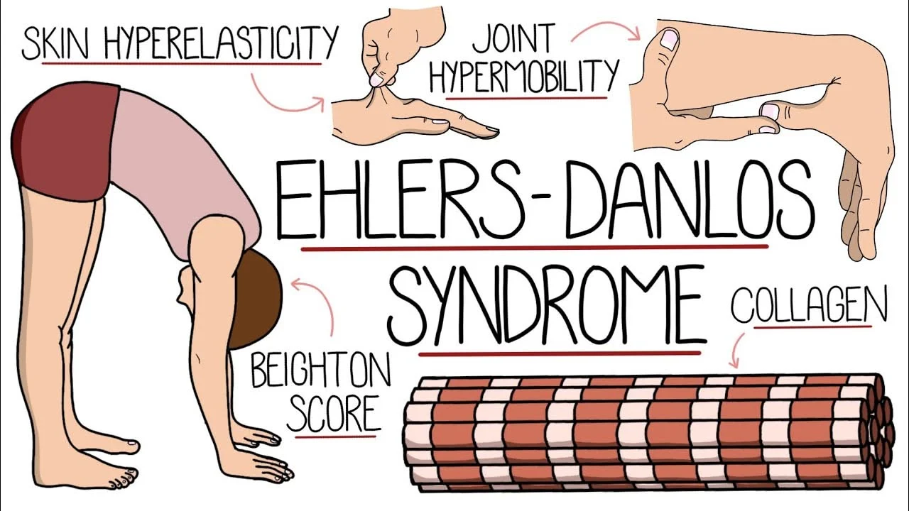 Penderita Hypermobile Ehlers-Danlos Syndrome Berbagi Pengalaman Hidup dengan Kesakitan Kronis